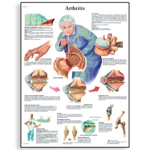 Picture of Arthritis Chart